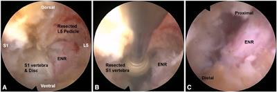 Endoscopic lumbar foraminotomy for foraminal stenosis in stable spondylolisthesis